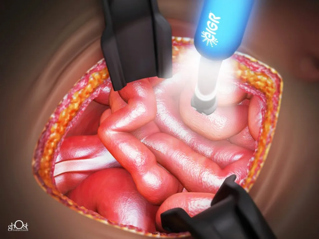 Invuity light surgery intestines 